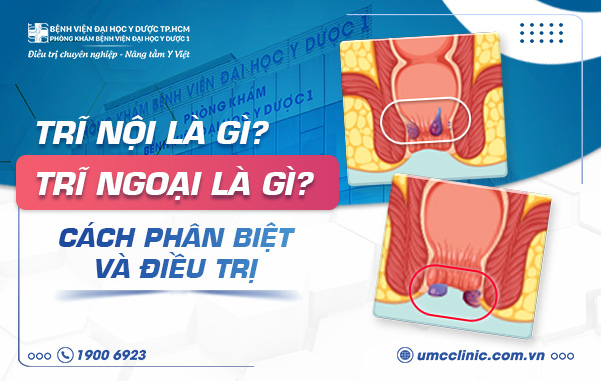 TRĨ NỘI LÀ GÌ? TRĨ NGOẠI LÀ GÌ? CÁCH PHÂN BIỆT VÀ ĐIỀU TRỊ