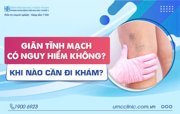 GIÃN TĨNH MẠCH CÓ NGUY HIỂM KHÔNG? KHI NÀO CẦN ĐI KHÁM