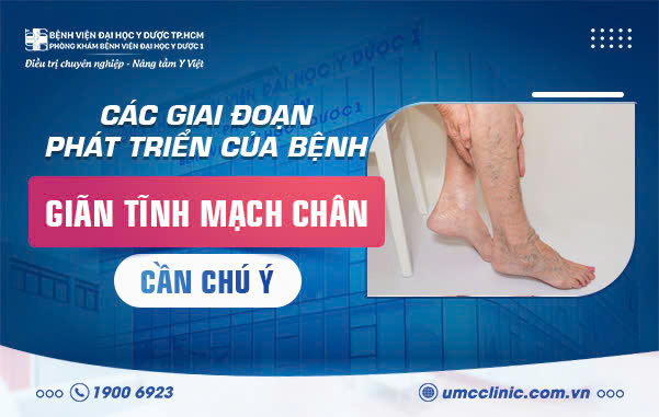 CÁC GIAI ĐOẠN PHÁT TRIỂN CỦA BỆNH GIÃN TĨNH MẠCH CHÂN CẦN LƯU Ý