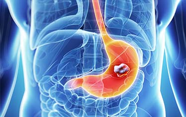 UNG THƯ DẠ DÀY NHỮNG ĐIỀU BẠN CẦN BIẾT