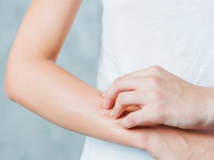 BỆNH CHÀM CÓ ĐÁNG LO NGẠI? (ECZEMA)