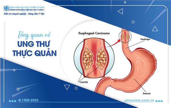 TỔNG QUAN VỀ UNG THƯ THỰC QUẢN