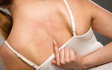 MỀ ĐAY MẠN TÍNH, CÓ PHẢI DO GAN YẾU?