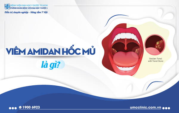 VIÊM AMIDAN HỐC MỦ: TRIỆU CHỨNG, NGUYÊN NHÂN, BIẾN CHỨNG VÀ CÁCH ĐIỀU TRỊ