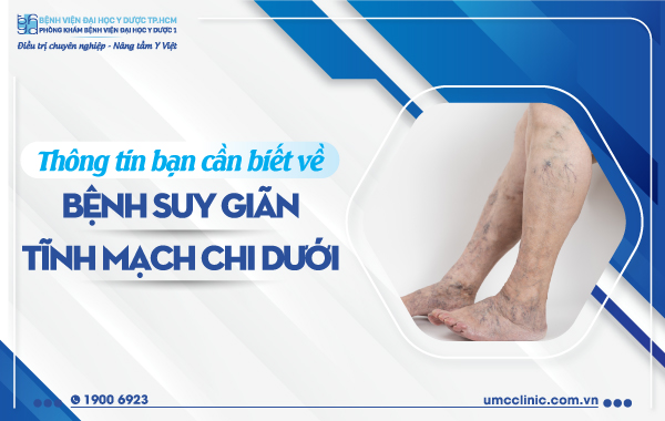THÔNG TIN BẠN CẦN BIẾT VỀ BỆNH SUY GIÃN TĨNH MẠCH CHI DƯỚI