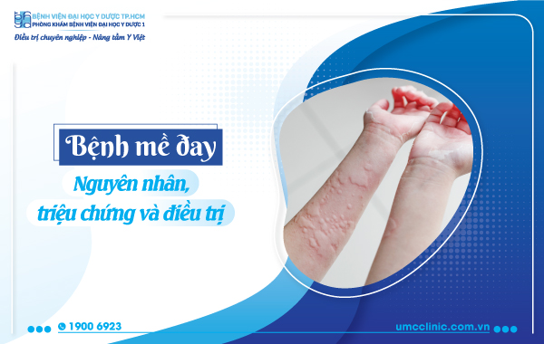 BỆNH MỀ ĐAY: NGUYÊN NHÂN, TRIỆU CHỨNG VÀ ĐIỀU TRỊ