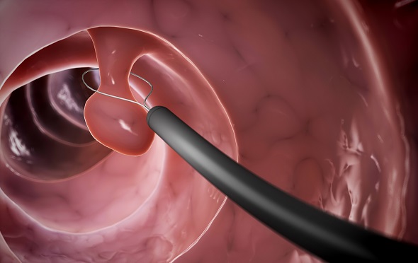 Cat polyp giup ngan ngua ung thu dai trang Cat polyp giup ngan ngua ung thu dai trang