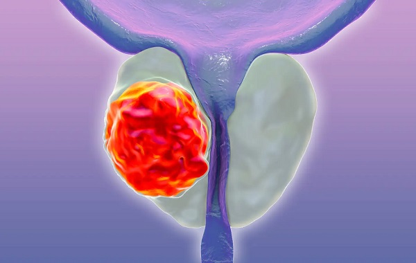 Nam-gioi-co-nguy-co-ung-thu-tuyen-tien-liet-nen-lam-xet-nghiem-psa